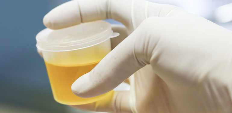 Hand holding container, urine test